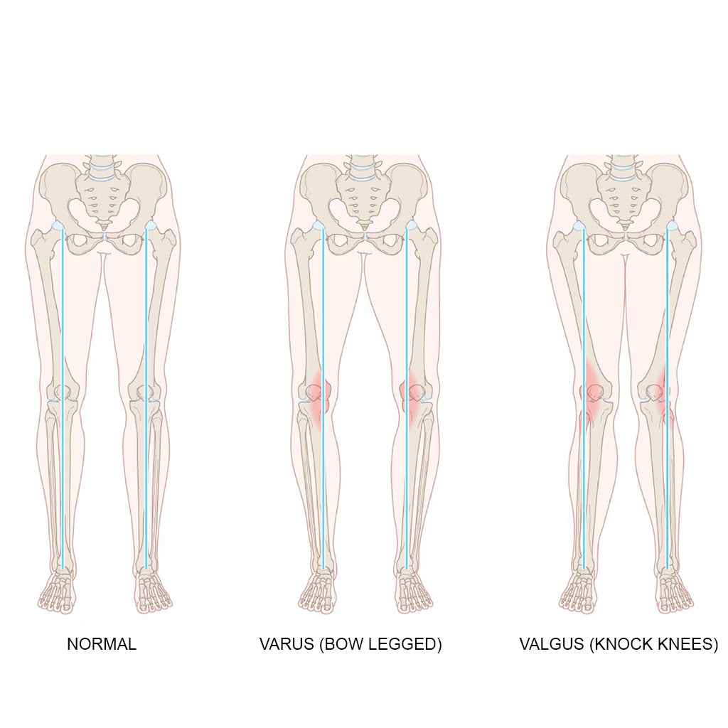 Tynor OA Knee Support | Neoprene Valgus & Varus