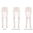 Tynor OA Knee Support | Neoprene Valgus & Varus